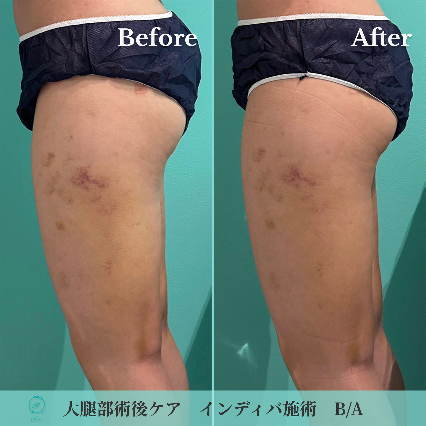 大腿部術後ケアのビフォーアフター画像