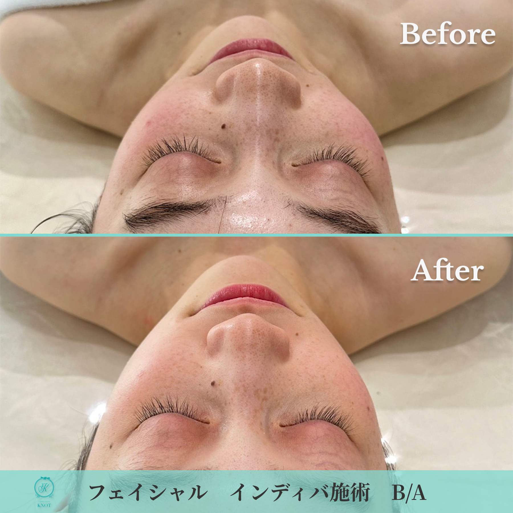 フェイシャルインディバ施術のビフォーアフター画像