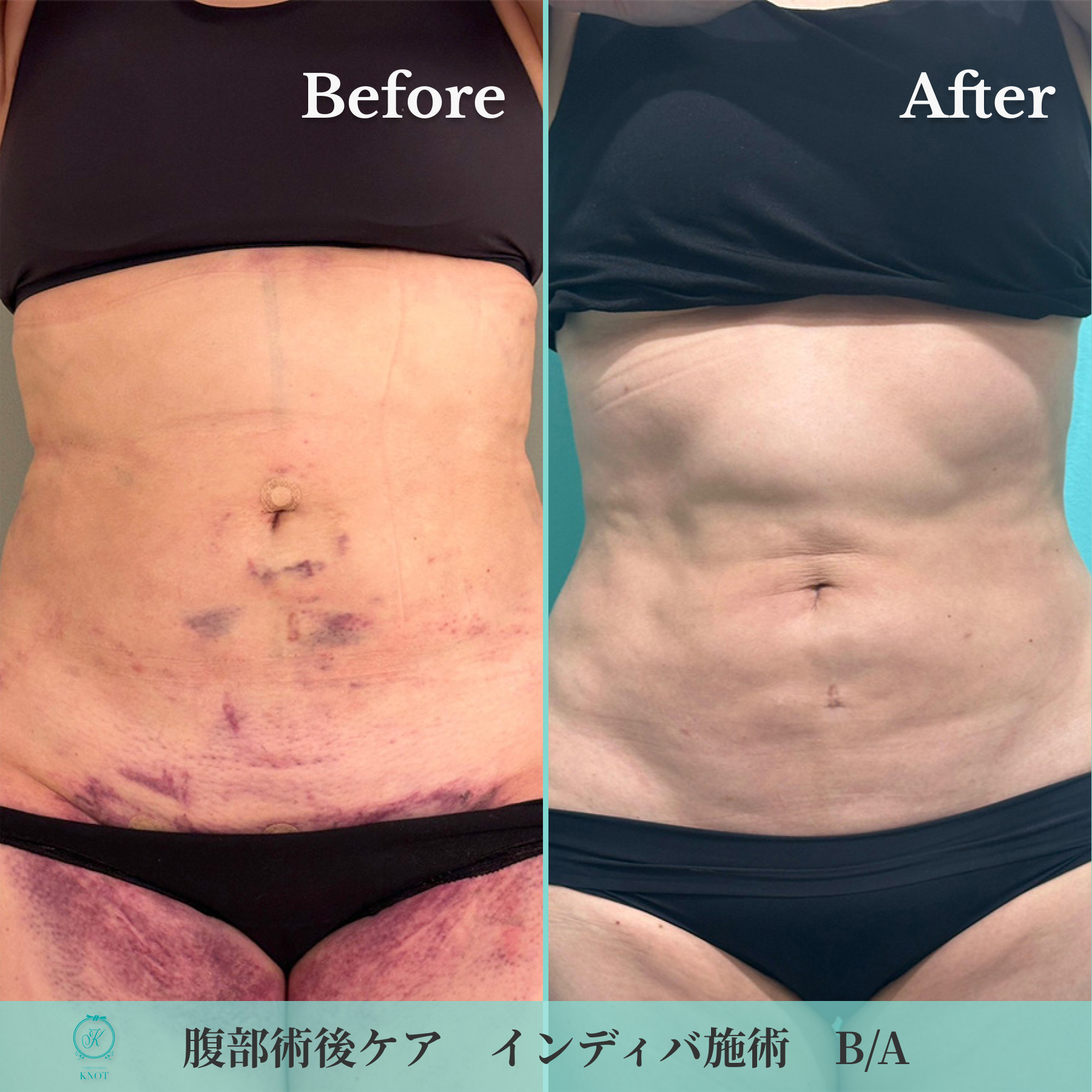 腹部術後ケアのビフォーアフター画像