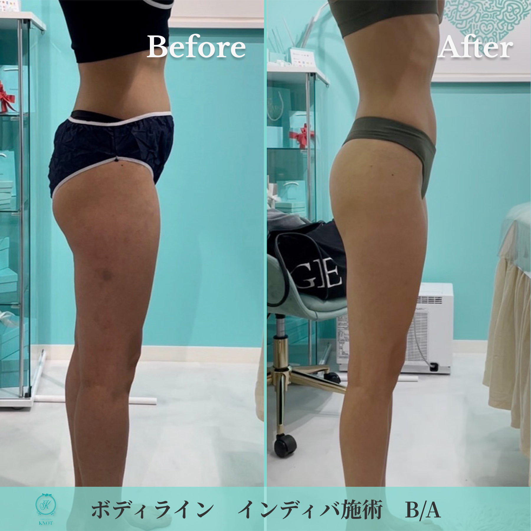 ボディラインインディバ施術のビフォーアフター画像