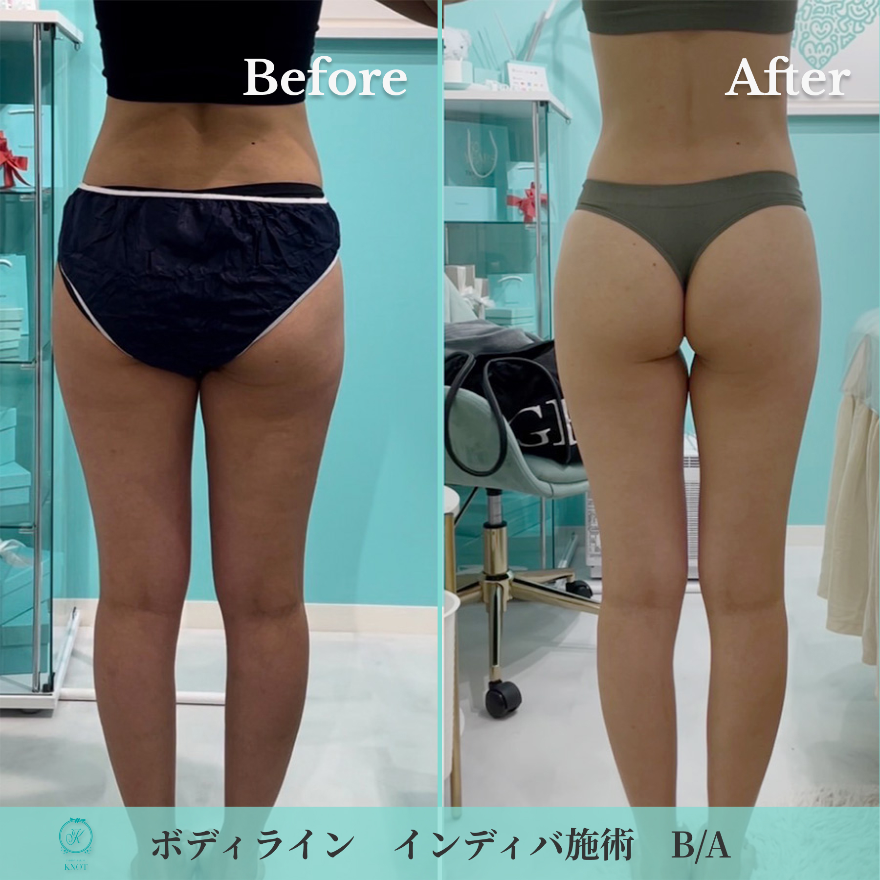 ボディラインインディバ施術のビフォーアフター画像