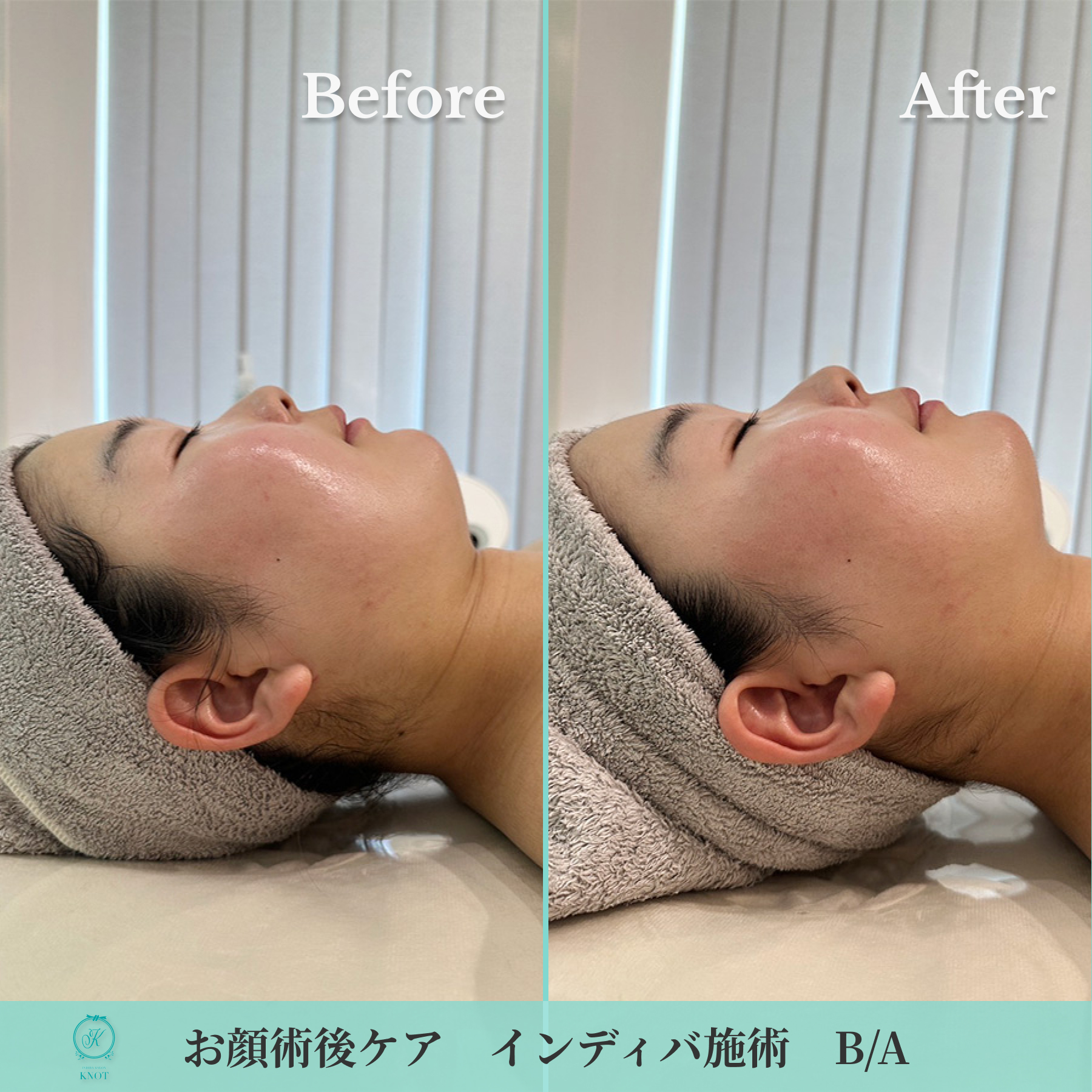 お顔周り術後ケアのビフォーアフター画像