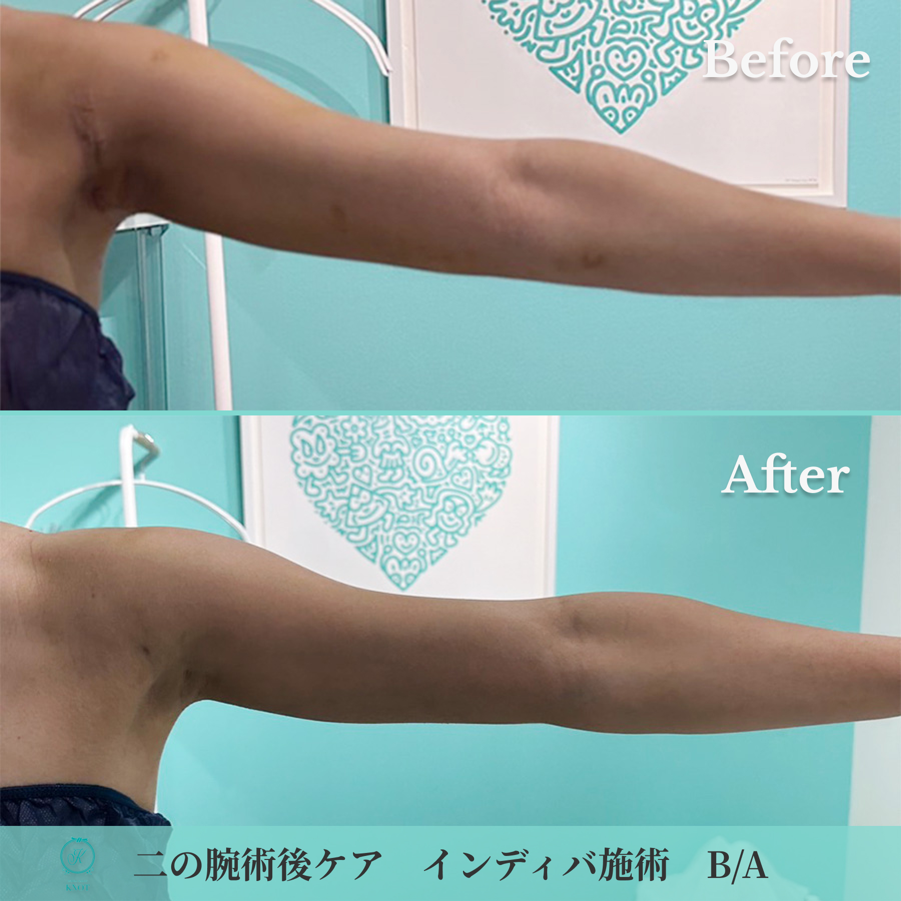 二の腕術後ケアのビフォーアフター画像