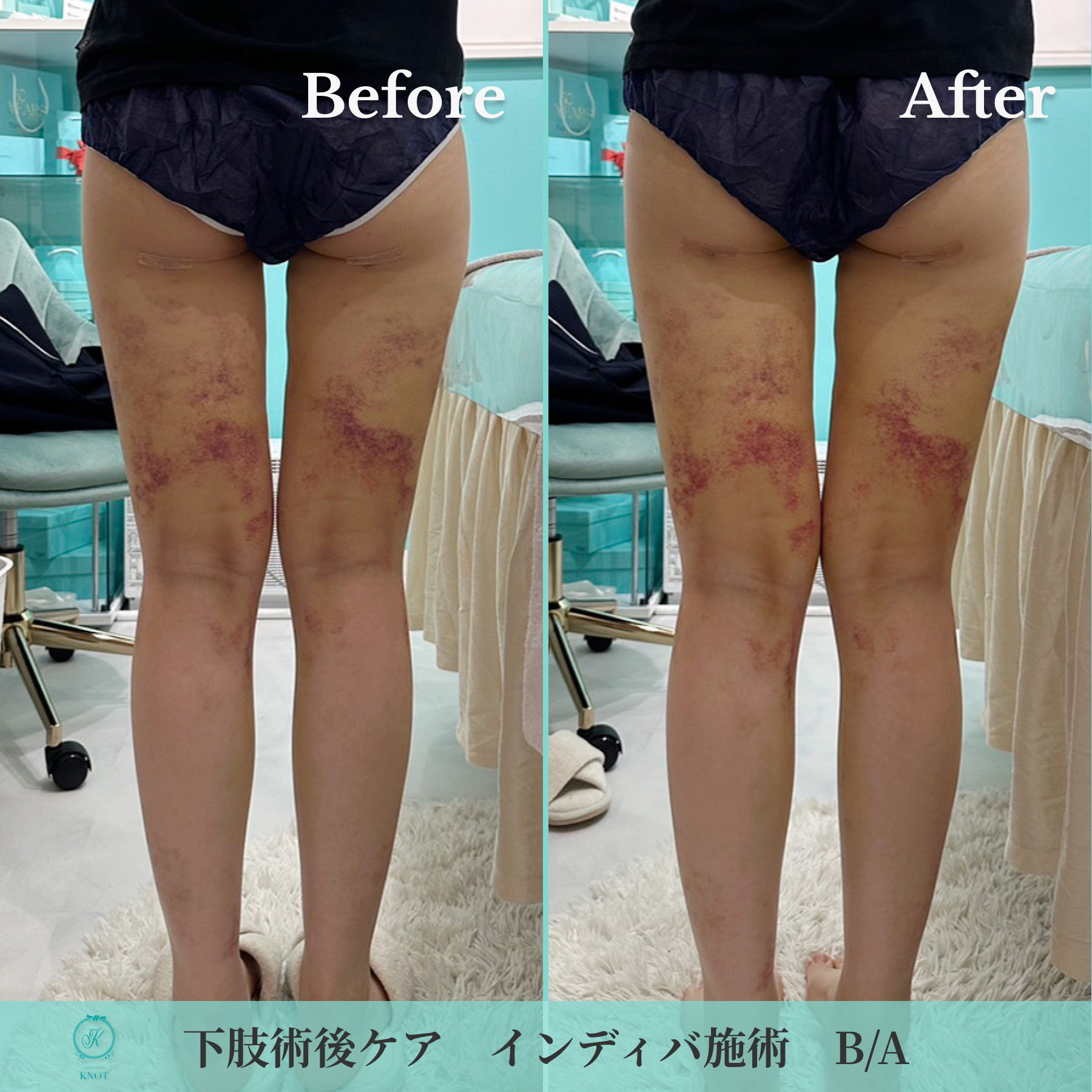 下肢術後ケアのビフォーアフター画像