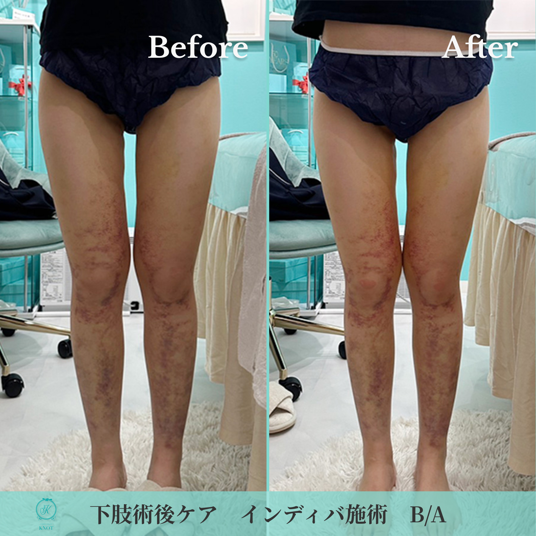 下肢術後ケアのビフォーアフター画像